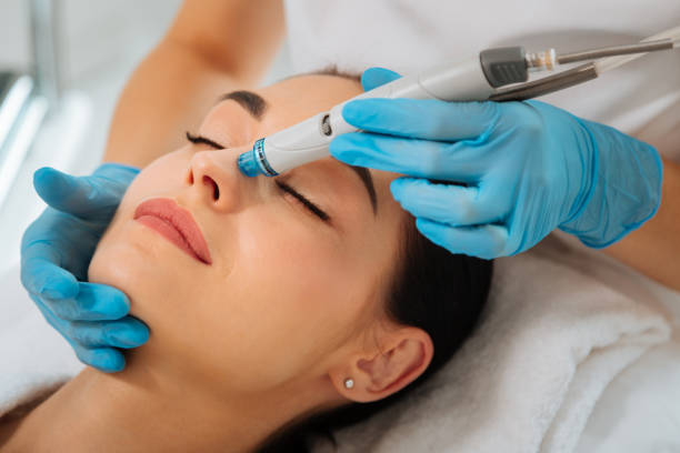 Microneedling session at Divaa Beauty