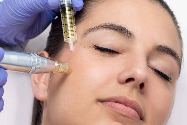 Client receiving PRP treatment at Divaa Beauty